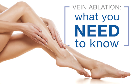 Vein Ablation: What You Need to Know