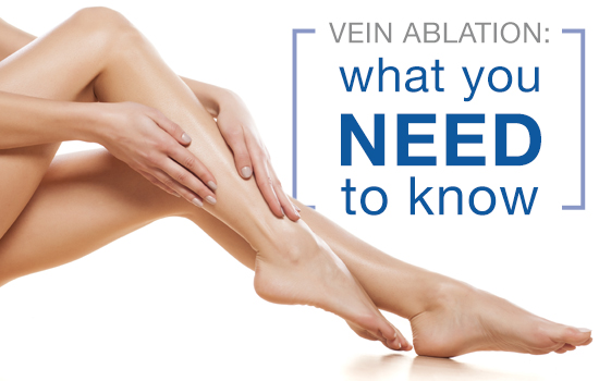 Vein ablation: what you need to know